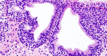 ¿Sufres cistitis con frecuencia? 8 remedios para prevenirla - INESEM