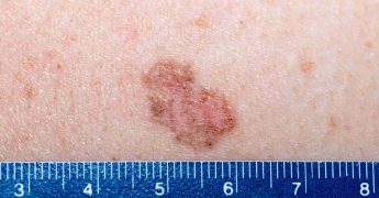 Carcinoma basocelular