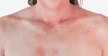 puntos rojos en la piel